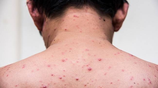 a man who having varicella blister or chickenpox
